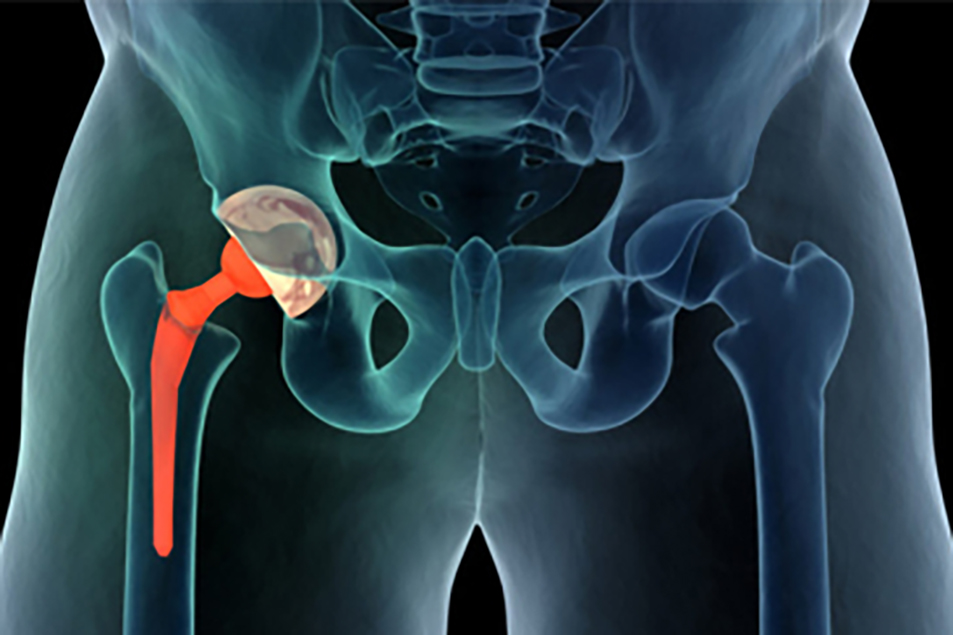 Read more about the article Hip Replacement Surgery