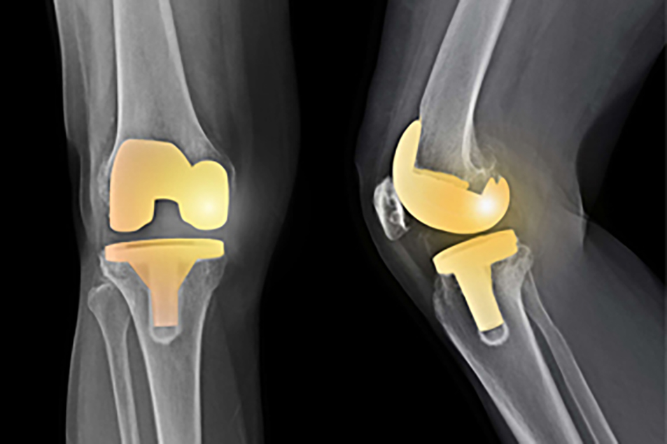 Read more about the article Knee Arthroscopy